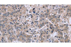 Immunohistochemistry of paraffin-embedded Human liver cancer tissue using EID1 Polyclonal Antibody at dilution 1:40 (EID1 anticorps)