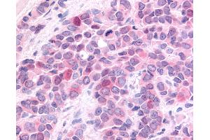 Anti-HUNK / B19 antibody IHC of human Breast, Carcinoma. (HUNK anticorps  (Internal Region))