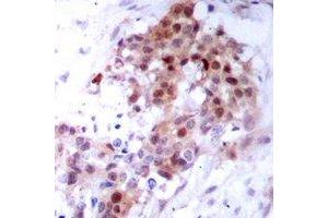 Immunohistochemical analysis of p38 staining in human breast cancer formalin fixed paraffin embedded tissue section.
