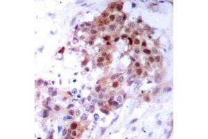 Immunohistochemical analysis of p38 staining in human breast cancer formalin fixed paraffin embedded tissue section. (MAPK14 anticorps)