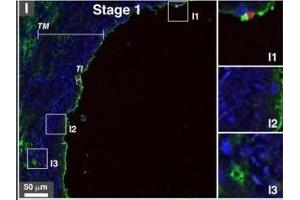 Immunohistological staining of artery tissues from diabetic subjects showing colocalization of serum proteins and mineral deposits.