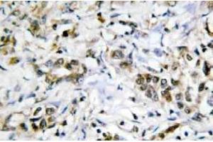 Immunohistochemistry (IHC) analyzes of Galectin-4 antibody in paraffin-embedded human liver carcinoma tissue. (GAL4 anticorps)