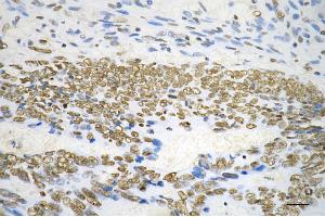 Immunohistochemistry was performed on paraffin-embedded human sigmoid colon carcinoma using BCL2 associated transcription factor 1 antibody (ABIN7797747), 1:200).