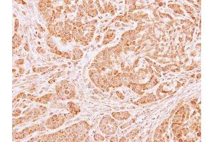 IHC-P Image Immunohistochemical analysis of paraffin-embedded A549 xenograft, using LARS2, antibody at 1:100 dilution.