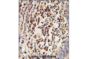 Formalin-fixed and paraffin-embedded human lung carcinoma reacted with MOSC2 Antibody , which was peroxidase-conjugated to the secondary antibody, followed by DAB staining.