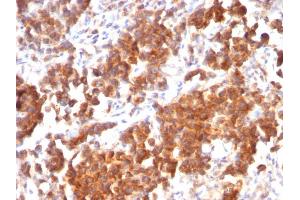 Formalin-fixed, paraffin-embedded human Parathyroid Mass stained with VEGI Mouse Recombinant Monoclonal Antibody (rVEGI /1283). (Recombinant TNFSF15 anticorps)