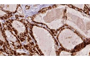 ABIN6267193 at 1/100 staining Human thyroid cancer tissue by IHC-P. (tau anticorps  (pSer416))