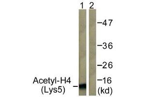 Immunohistochemistry analysis of paraffin-embedded human breast carcinoma tissue, using Histone H4 (Acetyl-Lys5) Antibody. (Histone H4 anticorps  (acLys5))
