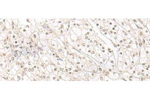 Immunohistochemistry of paraffin-embedded Human kidney cancer tissue using HENMT1 Polyclonal Antibody at dilution of 1:30(x200) (HENMT1 anticorps)