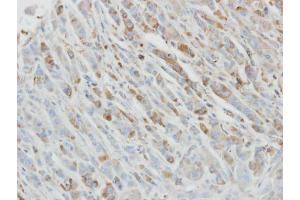 IHC-P Image Immunohistochemical analysis of paraffin-embedded PC3 xenograft, using IL1 Receptor antagonist, antibody at 1:500 dilution.