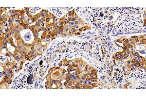 Detection of CK17 in Human Lung cancer Tissue using Polyclonal Antibody to Cytokeratin 17 (CK17)