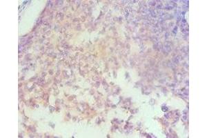 Immunohistochemistry of paraffin-embedded human cervical cancer using ABIN7155960 at dilution of 1:100 (HAS3 anticorps  (AA 339-553))