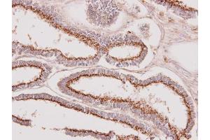 IHC-P Image Immunohistochemical analysis of paraffin-embedded human endometrial cancer, using GALNT7, antibody at 1:100 dilution. (GALNT7 anticorps  (Center))