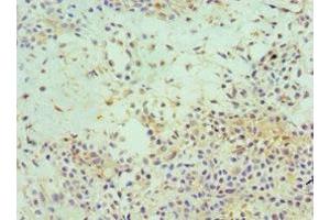 Immunohistochemistry of paraffin-embedded human breast cancer using ABIN7152153 at dilution of 1:100
