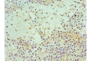 Immunohistochemistry of paraffin-embedded human breast cancer using ABIN7152153 at dilution of 1:100 (EIF3E anticorps  (AA 1-445))