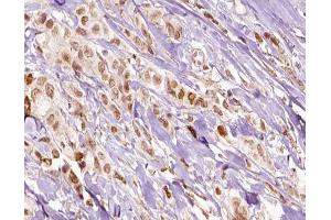 ABIN6266541 at 1/100 staining human breast carcinoma tissue sections by IHC-P. (FLI1 anticorps  (Internal Region))