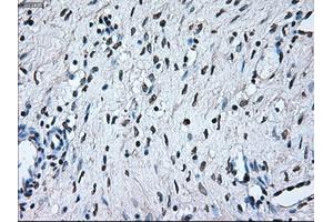 Immunohistochemical staining of paraffin-embedded Adenocarcinoma of colon tissue using anti-BRAFmouse monoclonal antibody. (BRAF anticorps)