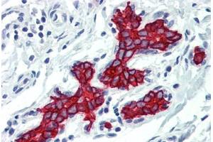 Human Breast (formalin-fixed, paraffin-embedded) stained with KRT19 antibody ABIN396942 at 10 ug/ml followed by biotinylated anti-mouse IgG secondary antibody ABIN481714, alkaline phosphatase-streptavidin and chromogen. (Cytokeratin 19 anticorps)