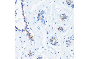 Immunohistochemistry of paraffin-embedded human breast cancer using HRAS antibody (ABIN7267785) at dilution of 1:100 (40x lens).