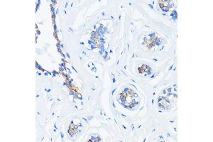 Immunohistochemistry of paraffin-embedded human breast cancer using HRAS antibody (ABIN7267785) at dilution of 1:100 (40x lens). (HRAS anticorps)
