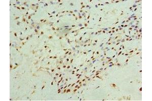 Immunohistochemistry of paraffin-embedded human breast cancer using ABIN7156601 at dilution of 1:100 (IFNGR1 anticorps  (AA 270-489))