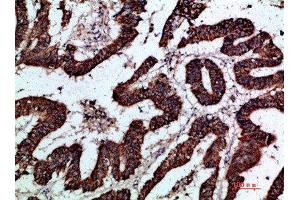 Immunohistochemical analysis of paraffin-embedded human-colon-cancer, antibody was diluted at 1:200 (GREM2 anticorps  (AA 71-120))