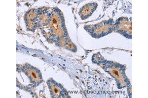 Immunohistochemistry of Human colon cancer using GMFG Polyclonal Antibody at dilution of 1:50 (GMFG anticorps)