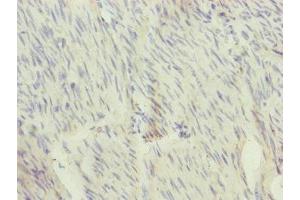 Immunohistochemistry of paraffin-embedded human bladder cancer using ABIN7166110 at dilution of 1:100