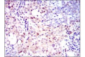 Immunohistochemical analysis of paraffin-embedded cervical cancer tissues using ASS1 mouse mAb with DAB staining. (ASS1 anticorps)