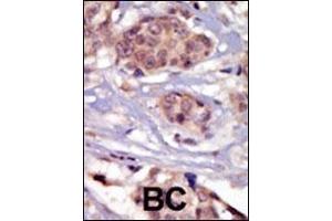 Formalin-fixed and paraffin-embedded human cancer tissue reacted with the primary antibody, which was peroxidase-conjugated to the secondary antibody, followed by DAB staining.
