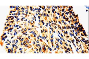 Immunohistochemistry of paraffin-embedded Human cervical cancer tissue using UTS2 Polyclonal Antibody at dilution 1:50 (Urotensin 2 anticorps)