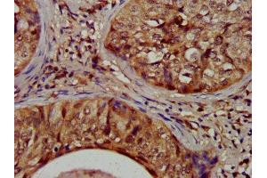 IHC image of ABIN7149534 diluted at 1:1200 and staining in paraffin-embedded human cervical cancer performed on a Leica BondTM system.