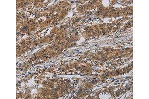 Immunohistochemistry of Human gastic cancer using INPPL1 Polyclonal Antibody at dilution of 1:40 (INPPL1 anticorps)
