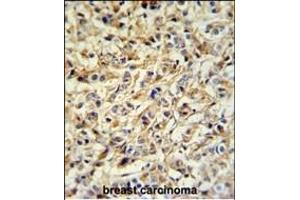 PRELP Antibody (Center) (ABIN652218 and ABIN2840925) IHC analysis in formalin fixed and paraffin embedded breast carcinoma followed by peroxidase conjugation of the secondary antibody and DAB staining. (PRELP anticorps  (AA 119-148))