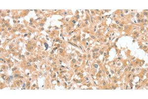 Immunohistochemistry of paraffin-embedded Human thyroid cancer using CIAPIN1 Polyclonal Antibody at dilution of 1:60 (CIAPIN1 anticorps)