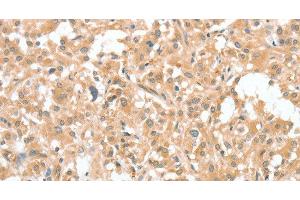 Immunohistochemistry of paraffin-embedded Human thyroid cancer using CIAPIN1 Polyclonal Antibody at dilution of 1:60
