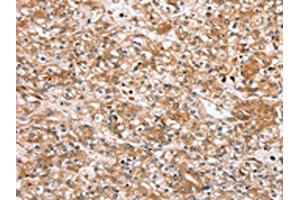The image on the left is immunohistochemistry of paraffin-embedded Human prostate cancer tissue using ABIN7192440(SLC25A20 Antibody) at dilution 1/30, on the right is treated with synthetic peptide. (SLC25A2 anticorps)