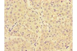 Immunohistochemistry of paraffin-embedded human liver cancer using ABIN7144725 at dilution of 1:100 (NARS anticorps  (AA 1-300))