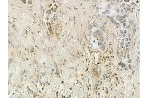 ABIN6257983 and ABIN6275857 at 1/100 staining human gastric carcinoma by IHC-P. (CAMKK2 anticorps  (C-Term))