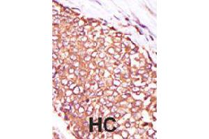 Formalin-fixed and paraffin-embedded human hepatocellular carcinoma tissue reacted with PRKCQ polyclonal antibody  , which was peroxidase-conjugated to the secondary antibody, followed by DAB staining . (PKC theta anticorps  (C-Term))