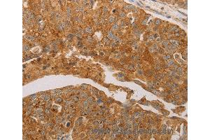 Immunohistochemistry of Human ovarian cancer using PRDX3 Polyclonal Antibody at dilution of 1:50 (Peroxiredoxin 3 anticorps)