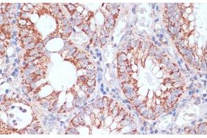 Immunohistochemistry of paraffin-embedded Human colon carcinoma using HIGD1A Polyclonal Antibody at dilution of 1:100 (40x lens). (HIGD1A anticorps)