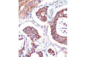 Immunohistochemistry of paraffin-embedded Human colon carcinoma using ME3 Rabbit pAb (ABIN7268384) at dilution of 1:100 (40x lens).