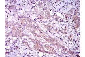 Immunohistochemical analysis of paraffin-embedded cervical cancer tissues using MAPK14 mouse mAb with DAB staining.