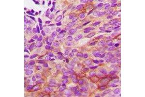 Immunohistochemical analysis of HSPB2 staining in human renal cancer formalin fixed paraffin embedded tissue section.