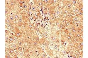Immunohistochemistry of paraffin-embedded human liver cancer using ABIN7147128 at dilution of 1:100 (CD177 anticorps  (AA 22-321))