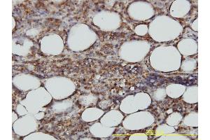 Immunoperoxidase of monoclonal antibody to STX6 on formalin-fixed paraffin-embedded human malignant lymphoma, diffuse large B tissue.