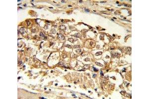 IHC analysis of FFPE human breast carcinoma with MCL1 antibody (MCL-1 anticorps  (AA 191-226))