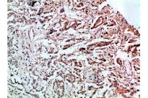 Immunohistochemical analysis of paraffin-embedded human-stomach-cancer, antibody was diluted at 1:200 (L1CAM anticorps  (AA 151-200))