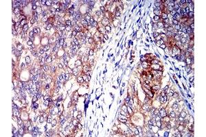 Immunohistochemical analysis of paraffin-embedded cervical cancer tissues using CD327 mouse mAb with DAB staining.